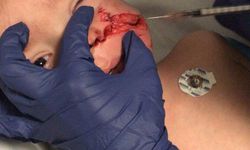 Ankara'da pitbull saldırısına uğrayan 1,5 ve 5 yaşındaki kardeşler yaralandı