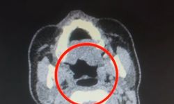 Midesinden yarım kilo metamfetamin çıktı