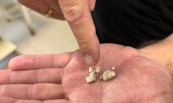 Tükürük bezinden, en büyüğü 2 santim olan 5 taş çıkarıldı