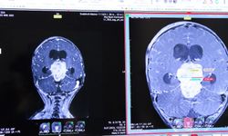 İstanbul - 2,5 yaşındaki Nikoloz'un beyninden 7 santimetrelik tümör çıkarıldı