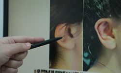 'Kepçe kulak ameliyatı özgüveni artırıyor'