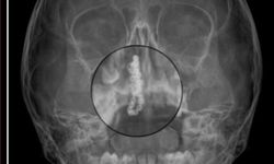 5 yaşındaki Polen, 2 yıldır burnunda tırnak makası zinciriyle yaşamış