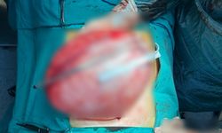 Kilolarından kurtulmak için doktora giden liseli kızın karnından 3,5 kilo ağırlığında kist çıktı