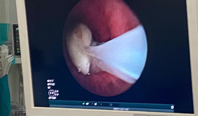 Hastanın akciğerine kaçan sarımsak operasyonla çıkarıldı