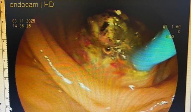 İç organları ters yönde olan hasta ERCP yöntemiyle sağlığına kavuştu
