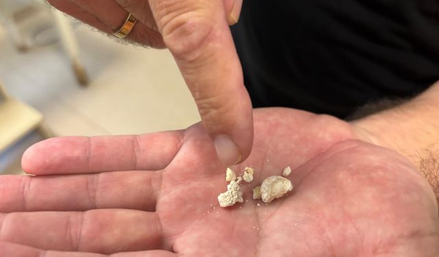 Tükürük bezinden, en büyüğü 2 santim olan 5 taş çıkarıldı