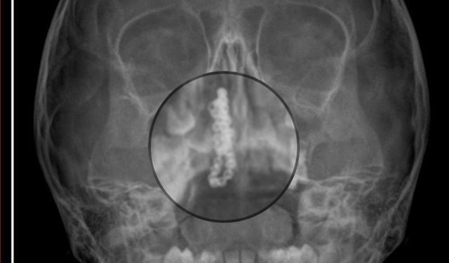 5 yaşındaki Polen, 2 yıldır burnunda tırnak makası zinciriyle yaşamış