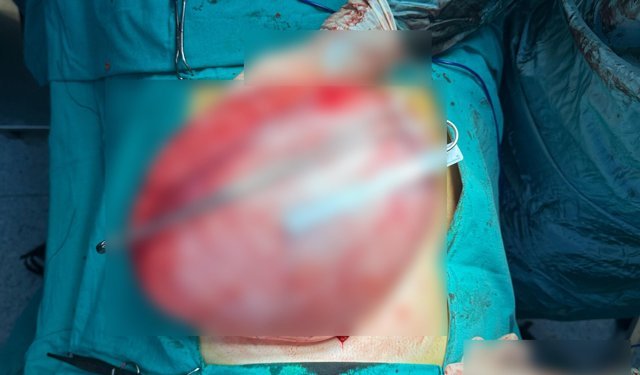 Kilolarından kurtulmak için doktora giden liseli kızın karnından 3,5 kilo ağırlığında kist çıktı