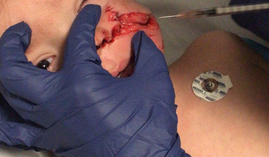 Ankara'da pitbull saldırısına uğrayan 1,5 ve 5 yaşındaki kardeşler yaralandı