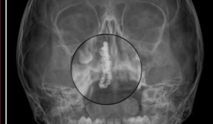 5 yaşındaki Polen, 2 yıldır burnunda tırnak makası zinciriyle yaşamış